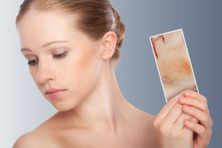 Dermite séborrhéique : quelles solutions contre cette maladie de la peau ?