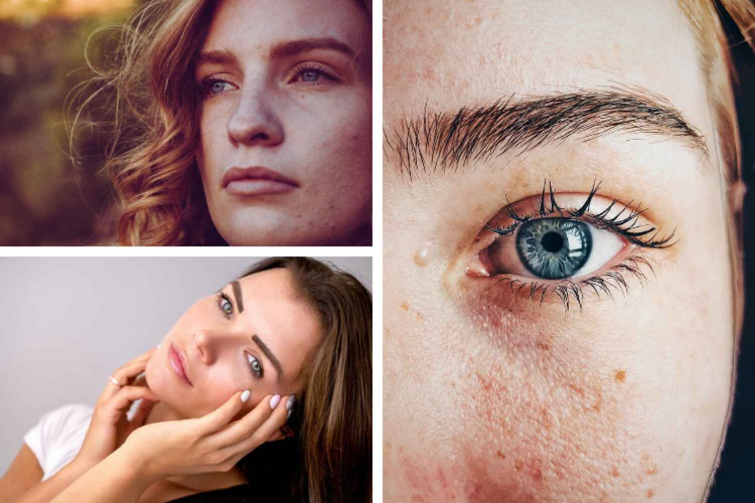 Acné hormonale : comment y remédier ?